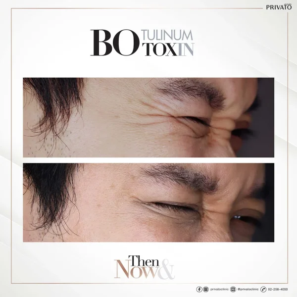 ภาพรวมผลลัพธ์โบท็อกซ์ตีนกา