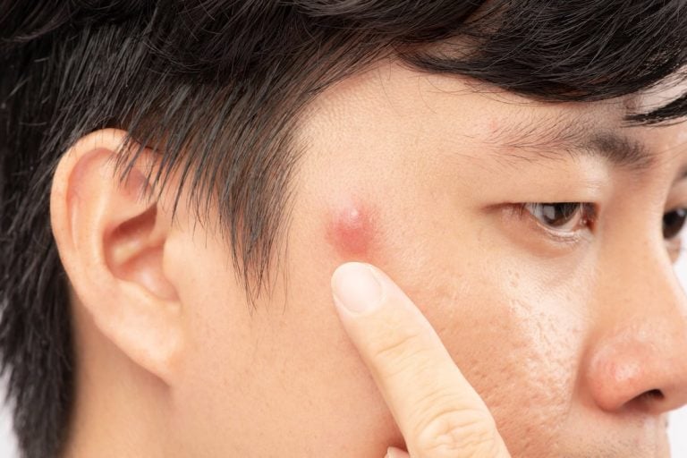 Understanding Cystic Acne: Causes & Treatment for Clear Skin