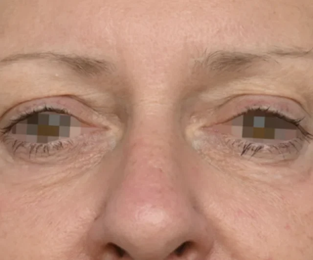 After EMFACE treatment around the eye area