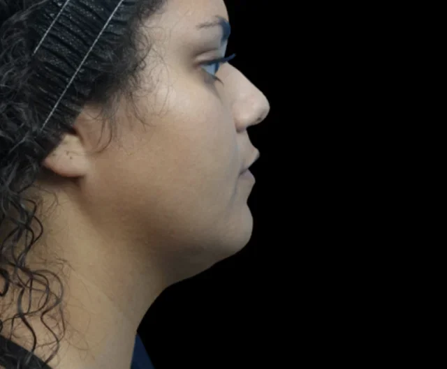 After EMFACE treatment, side jawline and under-chin view