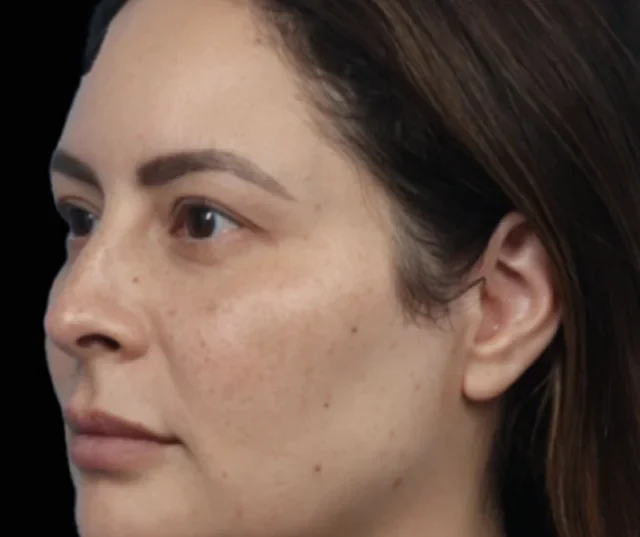 After EMFACE treatment, oblique cheek and jawline view