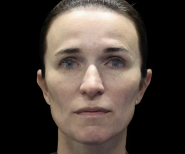 After EMFACE treatment, front view