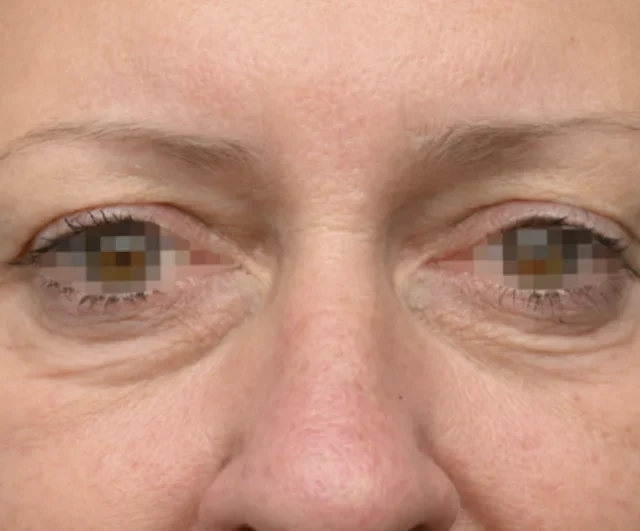 Before EMFACE treatment around the eye area