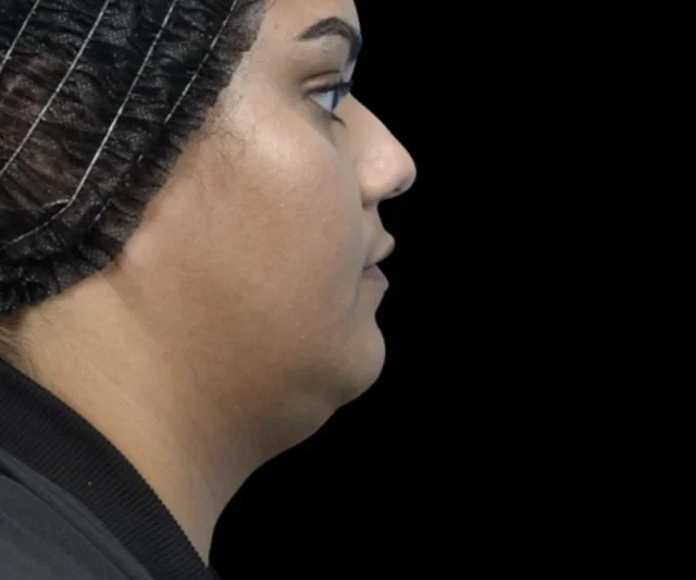 Before EMFACE treatment, side jawline and under-chin view