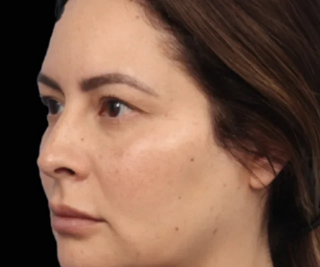 Before EMFACE treatment, oblique cheek and jawline view