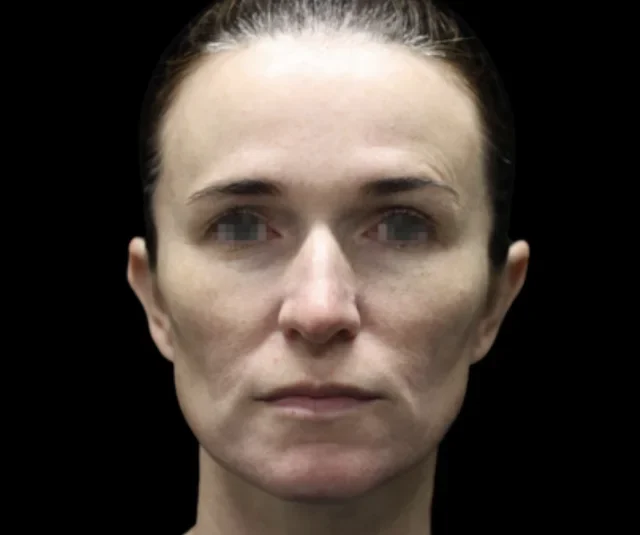 Before EMFACE treatment, front view
