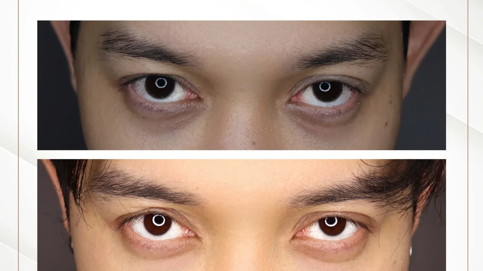 ภาพก่อน-หลังการรักษาถุงใต้ตาด้วยฟิลเลอร์