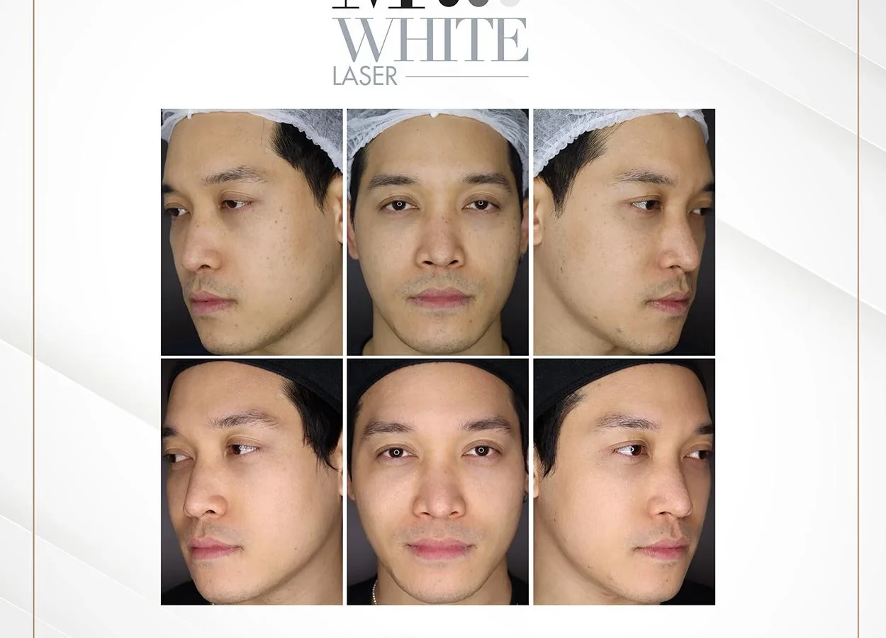 ก่อนการรักษาฝ้าจุดด่างดำด้วยเลเซอร์ M White