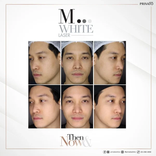ภาพก่อน-หลังการรักษาฝ้าจุดด่างดำด้วยเลเซอร์ M White