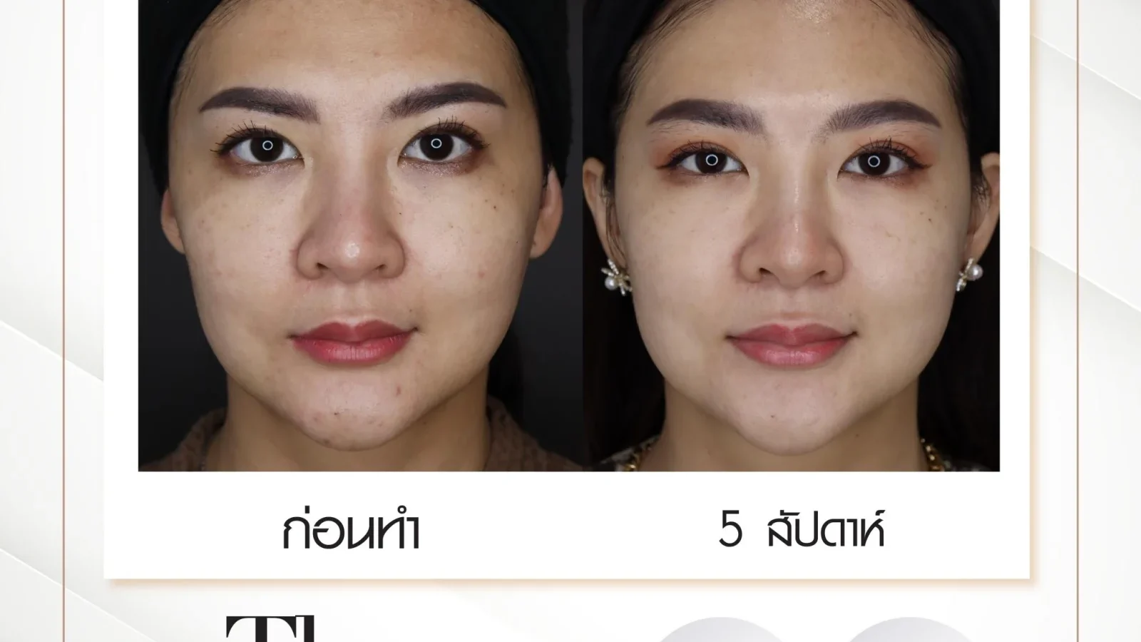 ภาพก่อน-หลังการรักษารอยสิวด้วยเลเซอร์ DY Shinning Bright