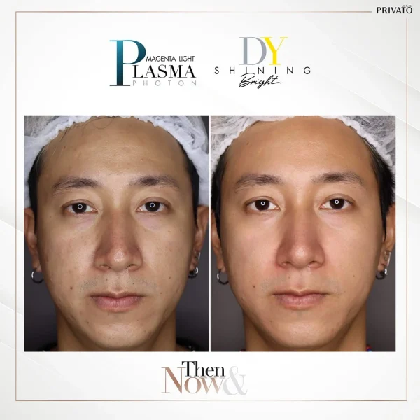 ภาพรวมผลลัพธ์การรักษารอยสิวด้วยเลเซอร์