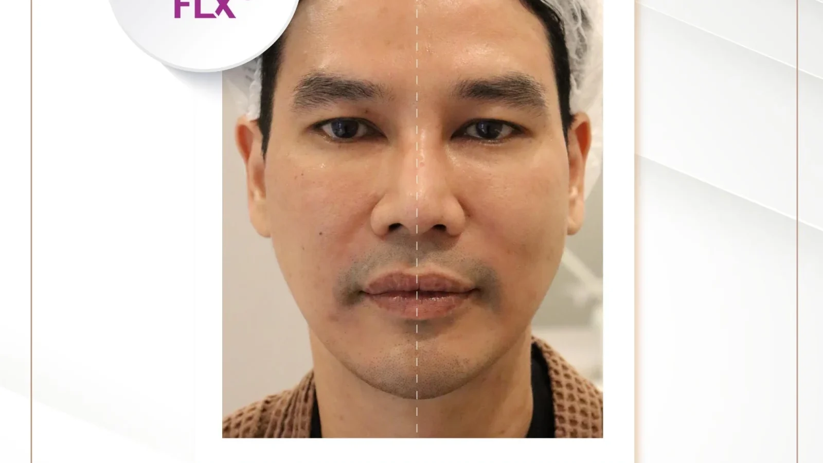 ภาพก่อน-หลังการรักษาหน้าหย่อนคล้อยด้วยโปรแกรมยกกระชับ Thermage