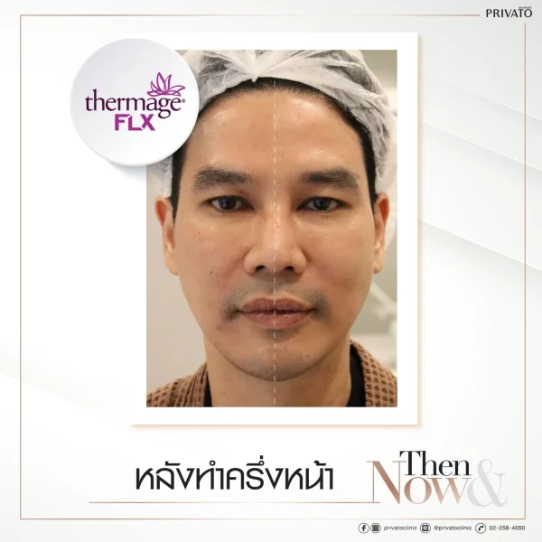 ภาพก่อน-หลังการรักษาหน้าหย่อนคล้อยด้วย Thermage
