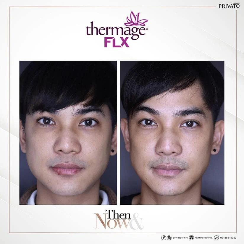 ก่อนการรักษาหน้าหย่อนคล้อยด้วย Thermage