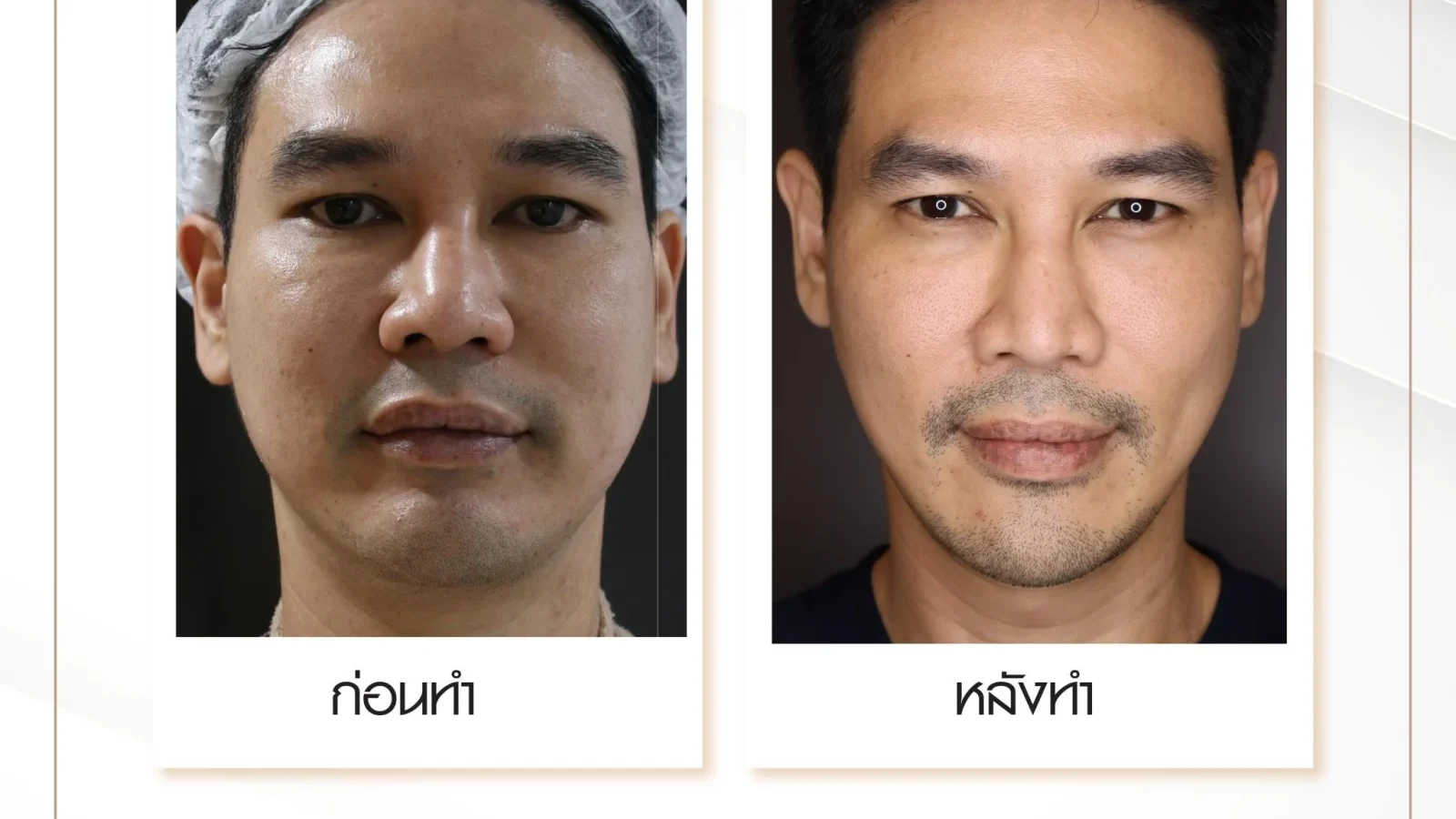ภาพก่อน-หลังการรักษาหน้าเหี่ยวด้วย Ulthera Thermage และ Potenza