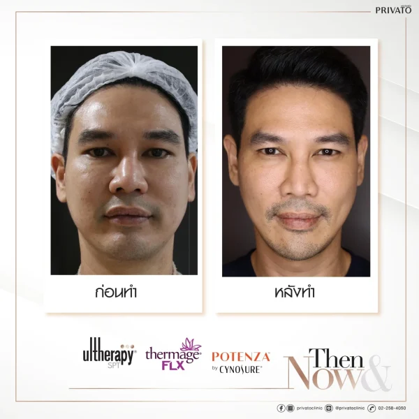 ผลลัพธ์การยกกระชับผิวด้วย Thermage