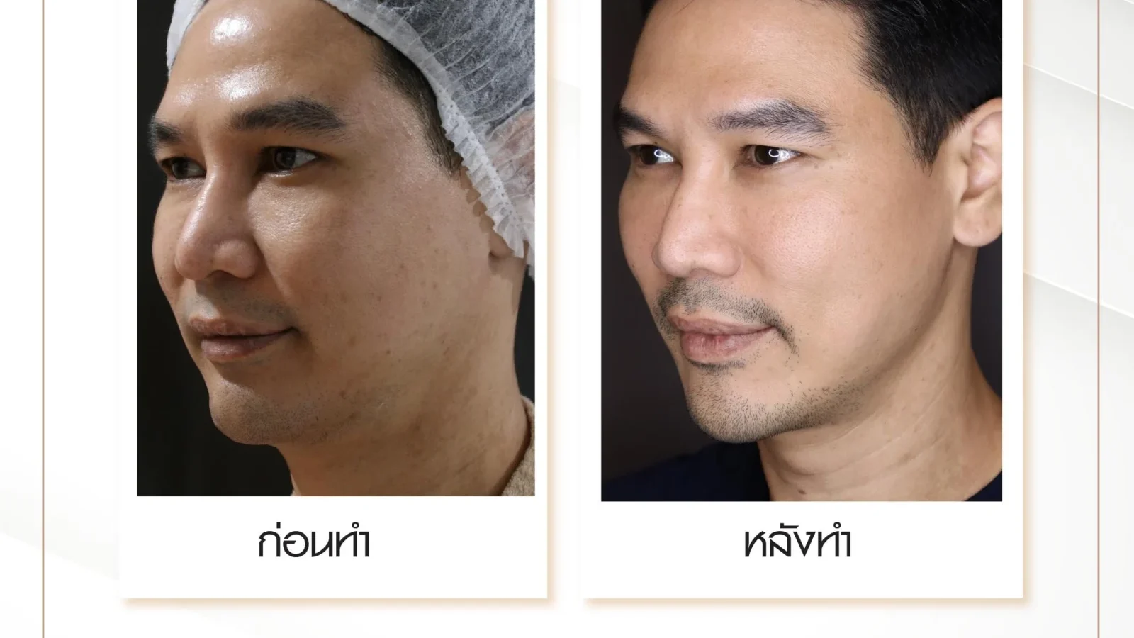 ภาพก่อน-หลังหน้าเหี่ยวด้วยโปรแกรมยกกระชับ Ulthera Thermage Potenza