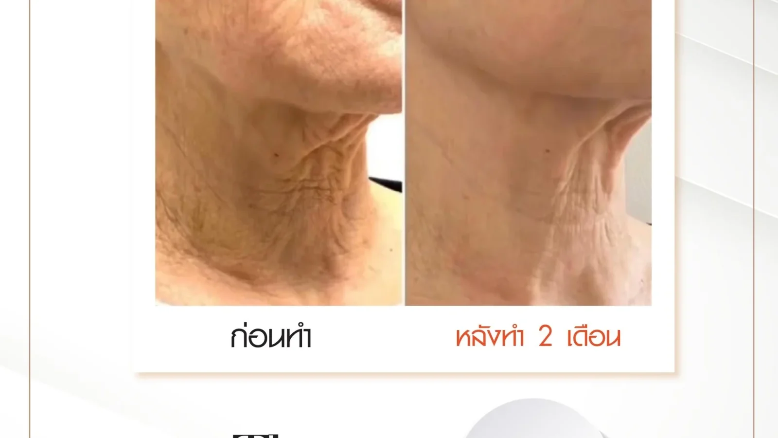 ก่อนการรักษาริ้วรอยด้วย Potenza