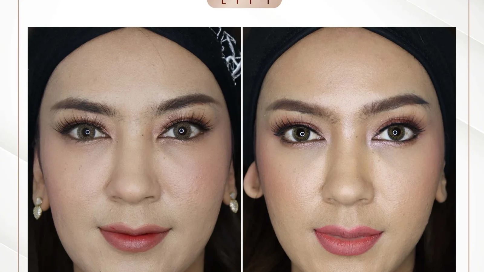 ก่อนการรักษาร่องแก้มลึกด้วย Ultimate Lift