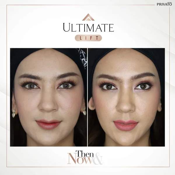 ภาพก่อน-หลังการรักษาร่องแก้มลึกด้วย Ultimate Lift