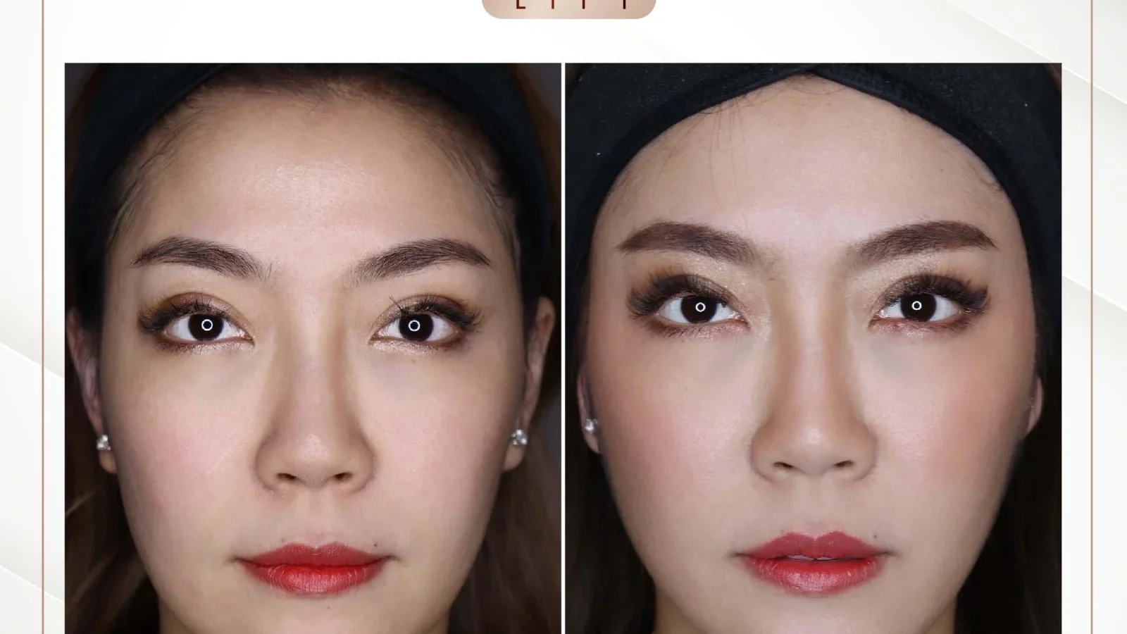 ก่อนการรักษาร่องแก้มลึกด้วย Ultimate Lift