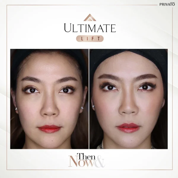 ภาพก่อน-หลังการรักษาร่องแก้มลึกด้วย Ultimate Lift