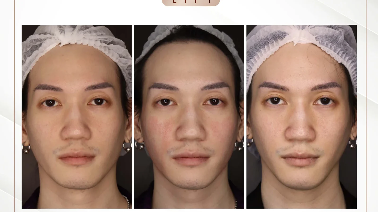 ก่อนการรักษาร่องแก้มลึกด้วย Ultimate Lift
