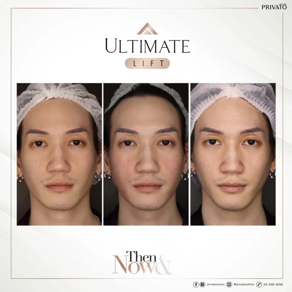 ภาพก่อน-หลังการรักษาร่องแก้มลึกด้วย Ultimate Lift