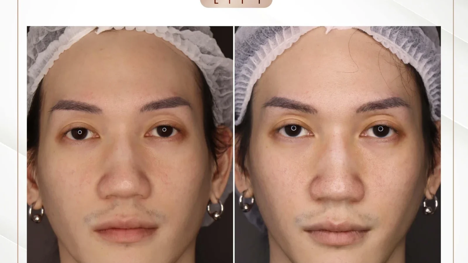 ก่อนการรักษาร่องแก้มลึกด้วย Ultimate Lift