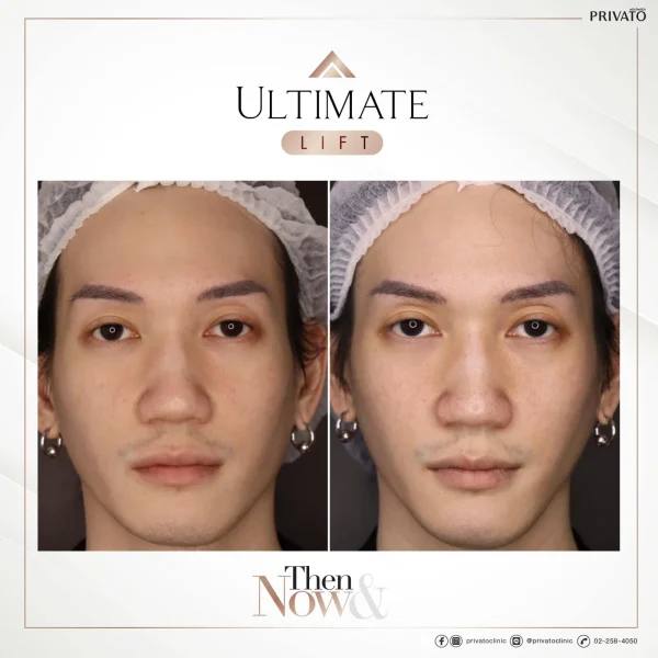 ภาพก่อน-หลังการรักษาร่องแก้มลึกด้วย Ultimate Lift