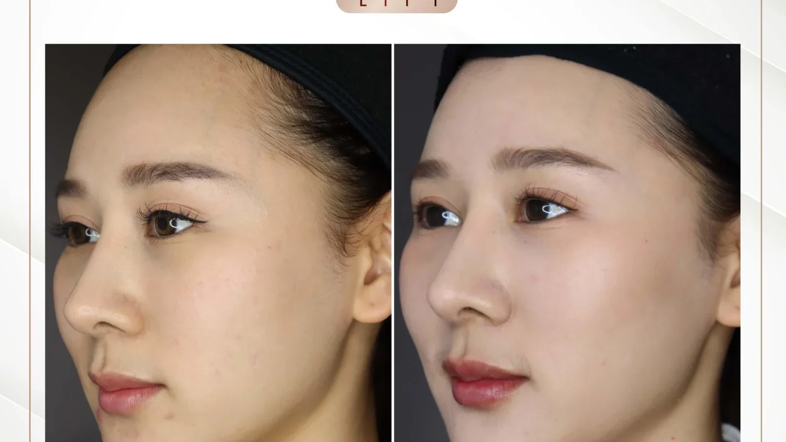 ก่อนการรักษาร่องแก้มลึกด้วย Ultimate Lift