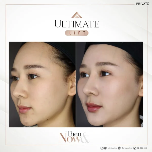 ก่อนการรักษาร่องแก้มลึกด้วย Ultimate Lift