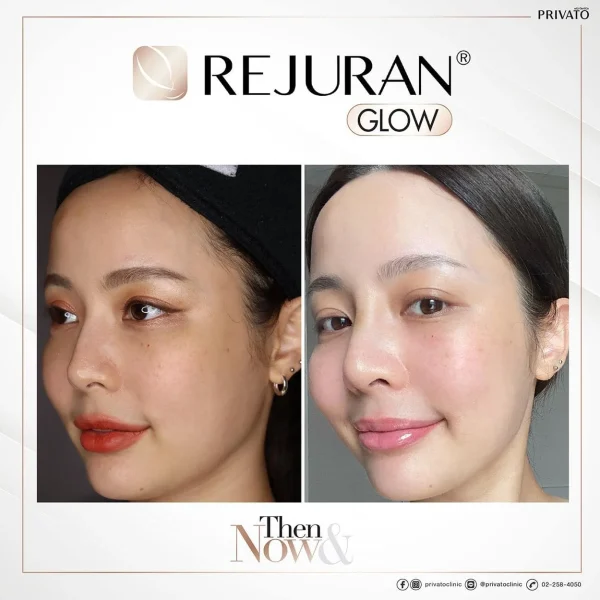 ตัวอย่างผลลัพธ์การฟื้นฟูผิวด้วย Rejuran