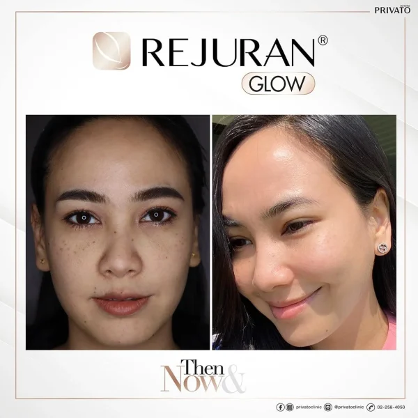 ตัวอย่างผลลัพธ์ผิวกระจ่างใสจาก Rejuran