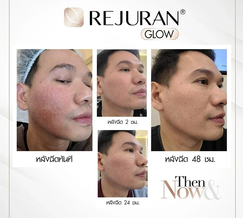 ภาพก่อน-หลังการรักษาผิวแห้งด้วย Rejuran