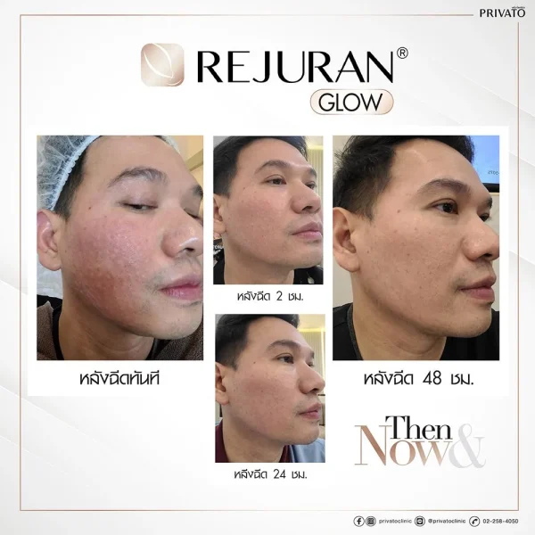 ตัวอย่างผลลัพธ์การบำรุงผิวจาก Rejuran