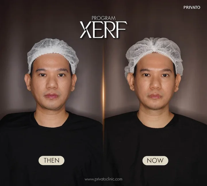 XERF before and after example at Privato Clinic, case 01