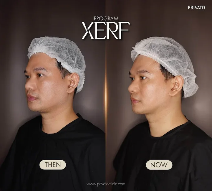XERF before and after example at Privato Clinic, case 02