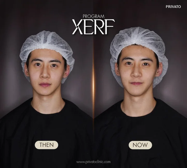 XERF before and after example at Privato Clinic, case 03