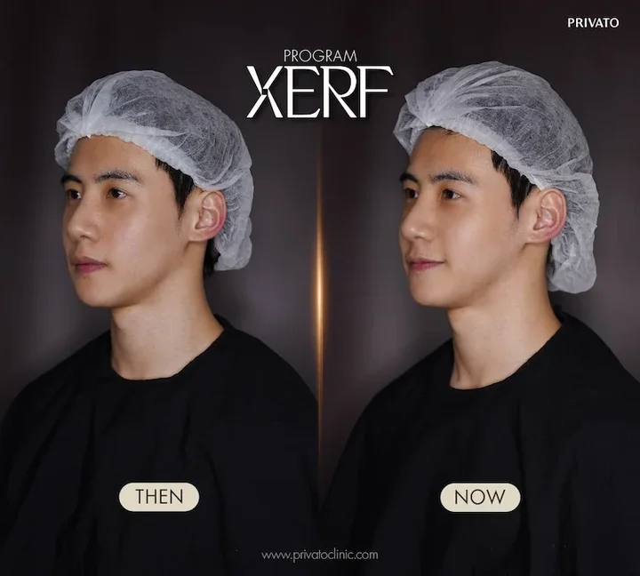 XERF before and after example at Privato Clinic, case 04