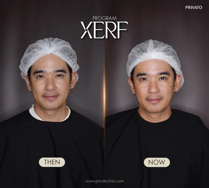 XERF before and after example at Privato Clinic, case 05