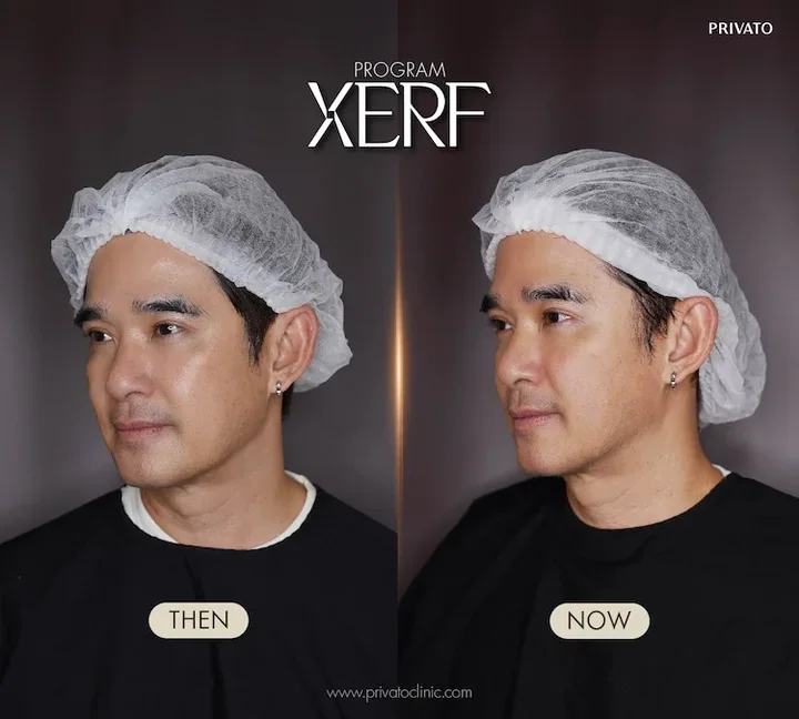 XERF before and after example at Privato Clinic, case 06