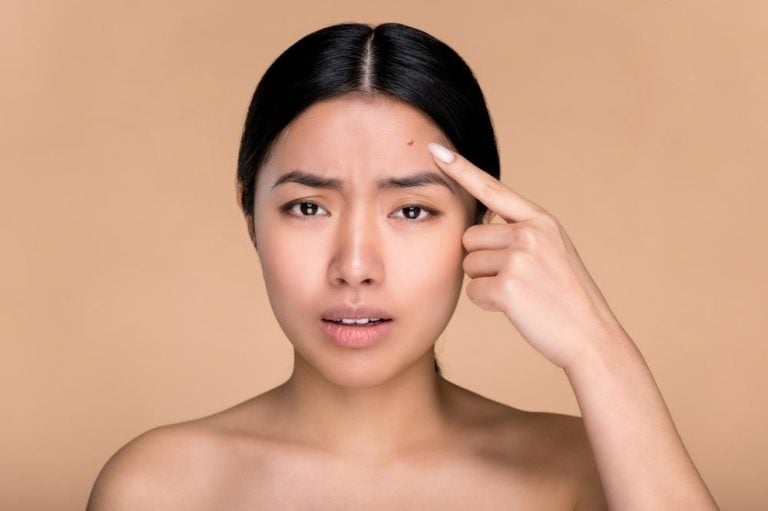บอกลาปัญหา “สิวขึ้นหน้าผาก” เข้าใจสาเหตุและรักษาให้ตรงจุด