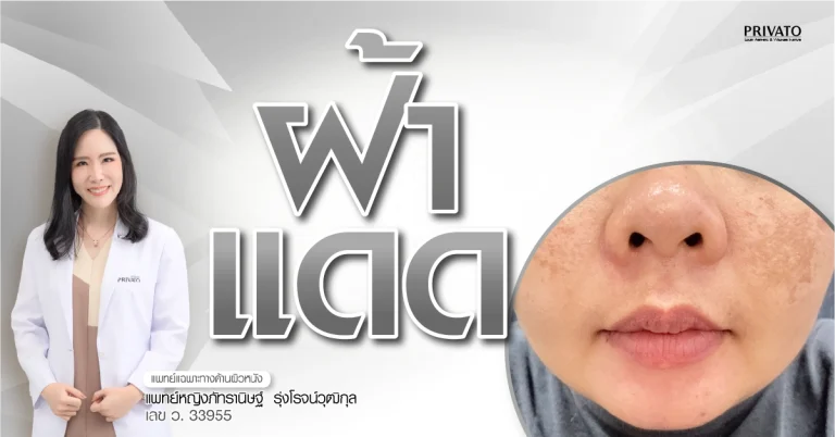 ฝ้าแดด คืออะไร สาเหตุ ลักษณะอาการ และวิธีรักษาให้หายขาด