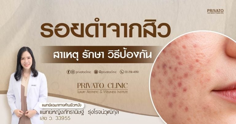 รอยดำจากสิว: สาเหตุ วิธีดูแล และการรักษาที่ได้ผล