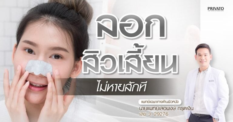 ลอกสิวเสี้ยน วิธีที่ถูกต้อง ลดความเสี่ยงรูขุมขนกว้าง
