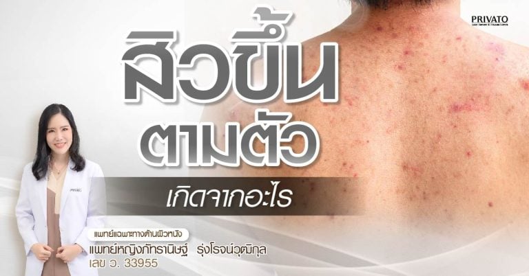 สิวขึ้นตามตัวเกิดจากอะไร? แก้ยังไงให้ยุบไว ลดโอกาสกลับมาเป็นซ้ำ