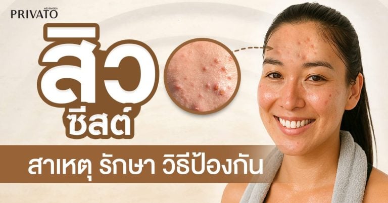 สิวซีสต์: สาเหตุ การรักษา และวิธีป้องกันที่ถูกต้อง