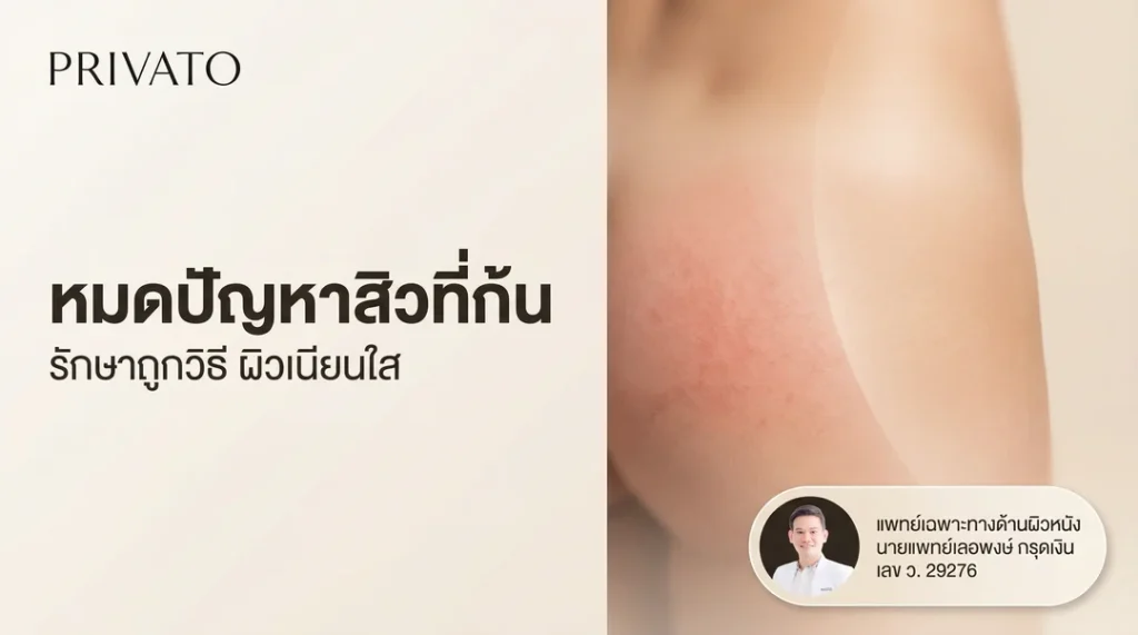 สิวที่ก้นเกิดจากอะไร? รวมวิธีรักษาสิวที่ก้นให้เนียนใสและวิธีป้องกันไม่ให้กลับมาเป็นซ้ำ