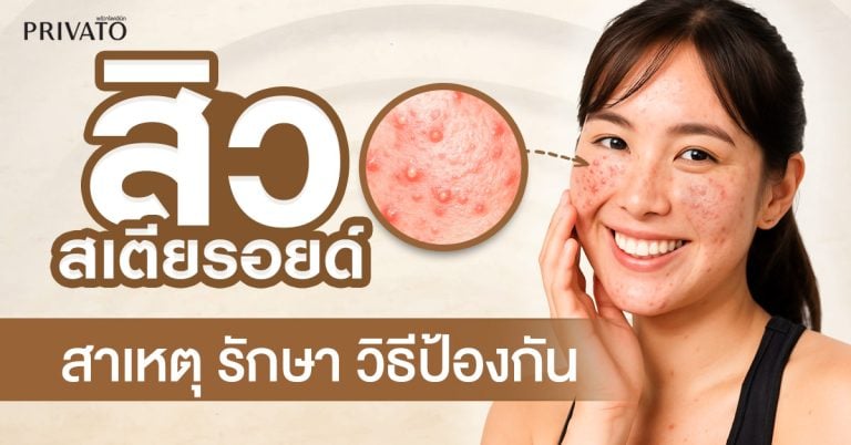 สิวสเตียรอยด์: สาเหตุ การรักษา และวิธีป้องกันที่ถูกต้อง